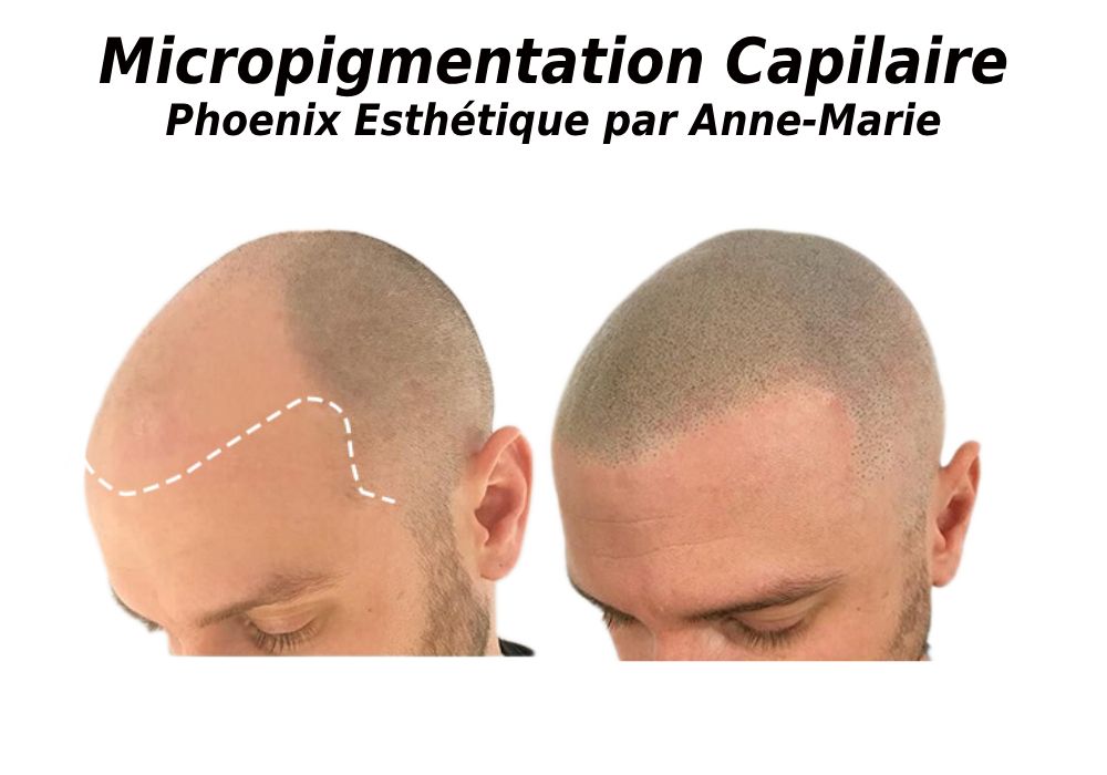 Microneedling à L'Assomption chez Phoenix Esthétique par Anne-Marie