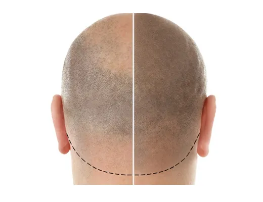Micropigmentation capillaire à prix réduit pour une apparence naturelle