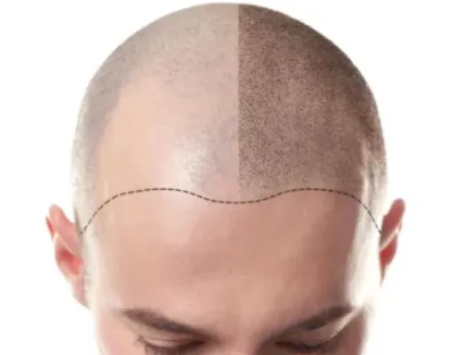 Rabais spécial sur la micropigmentation